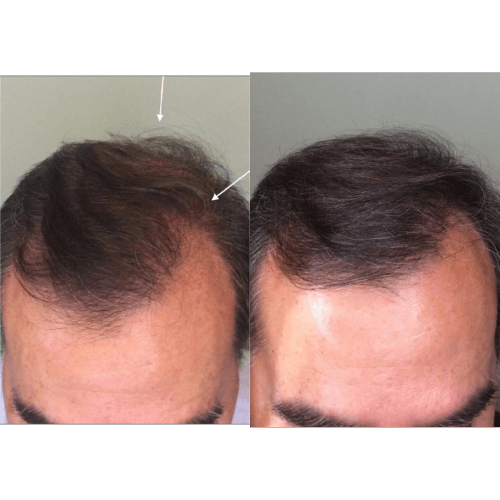 Before and after hair restoration comparison.