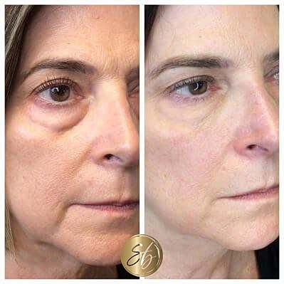 Upper Face Filler Before & After