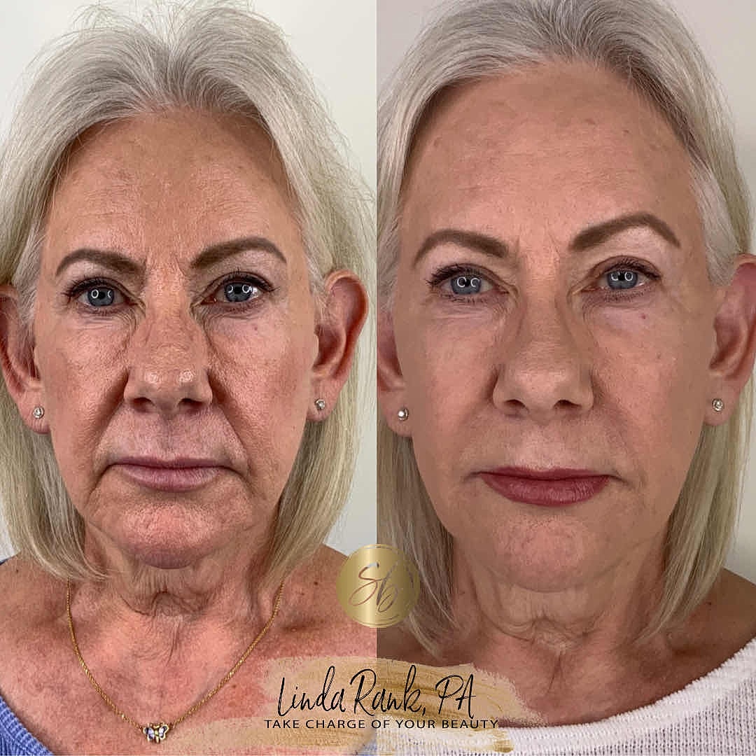 Facial Balancing Before & After