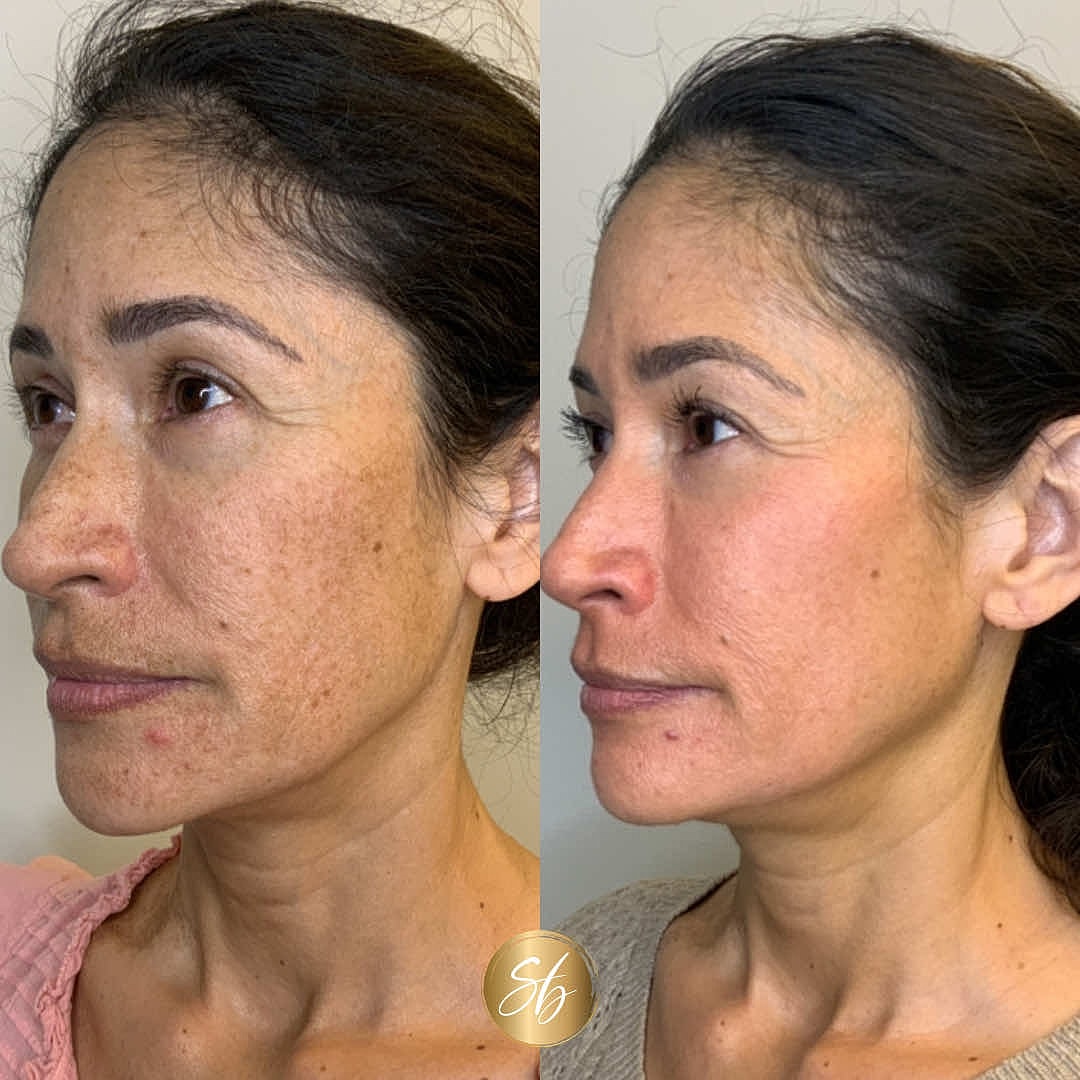 Facial Balancing Before & After