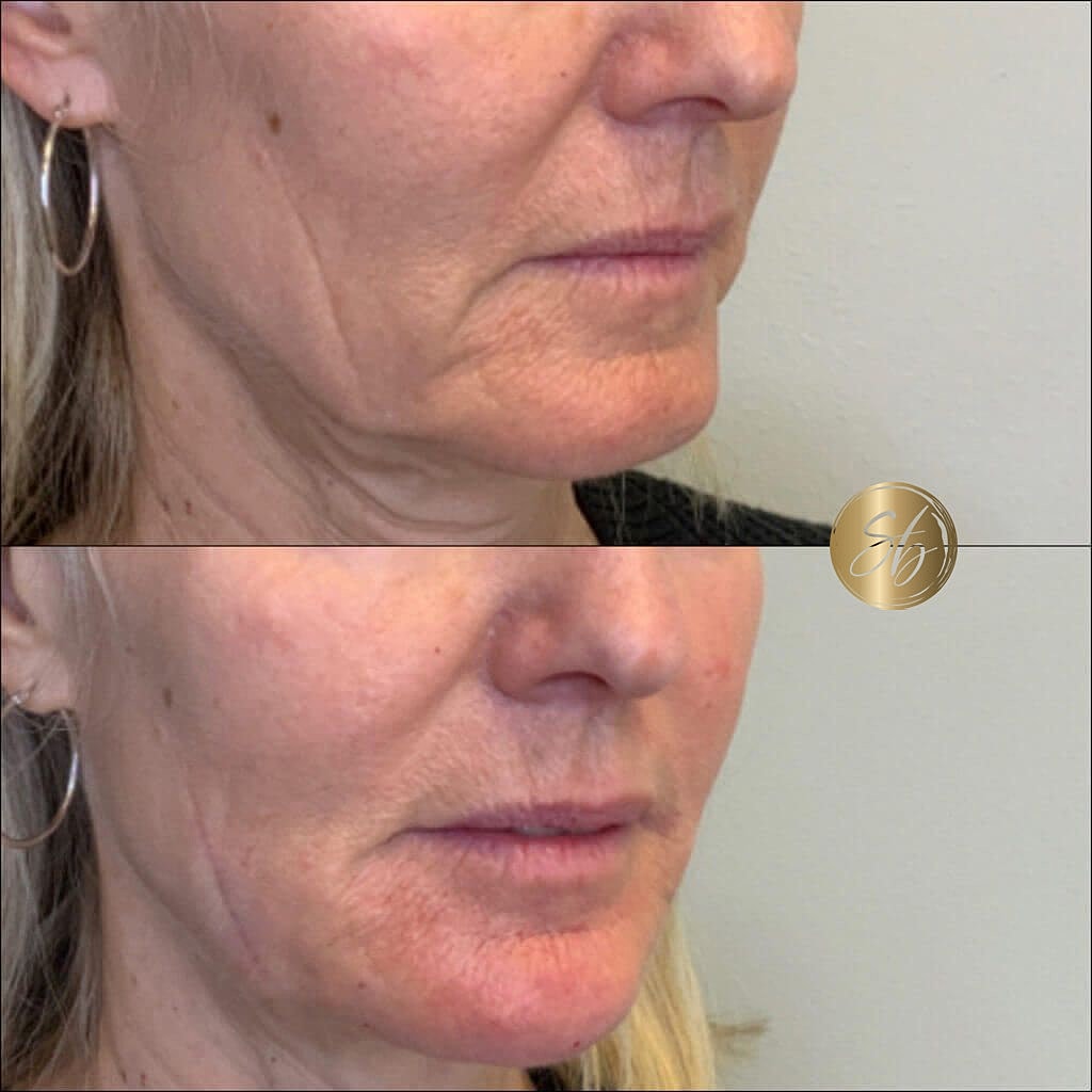 Facial Balancing Before & After