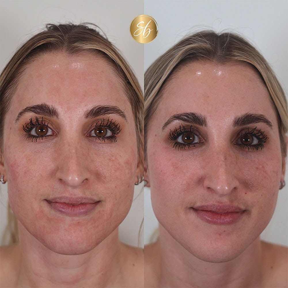 Before and after skincare treatment comparison