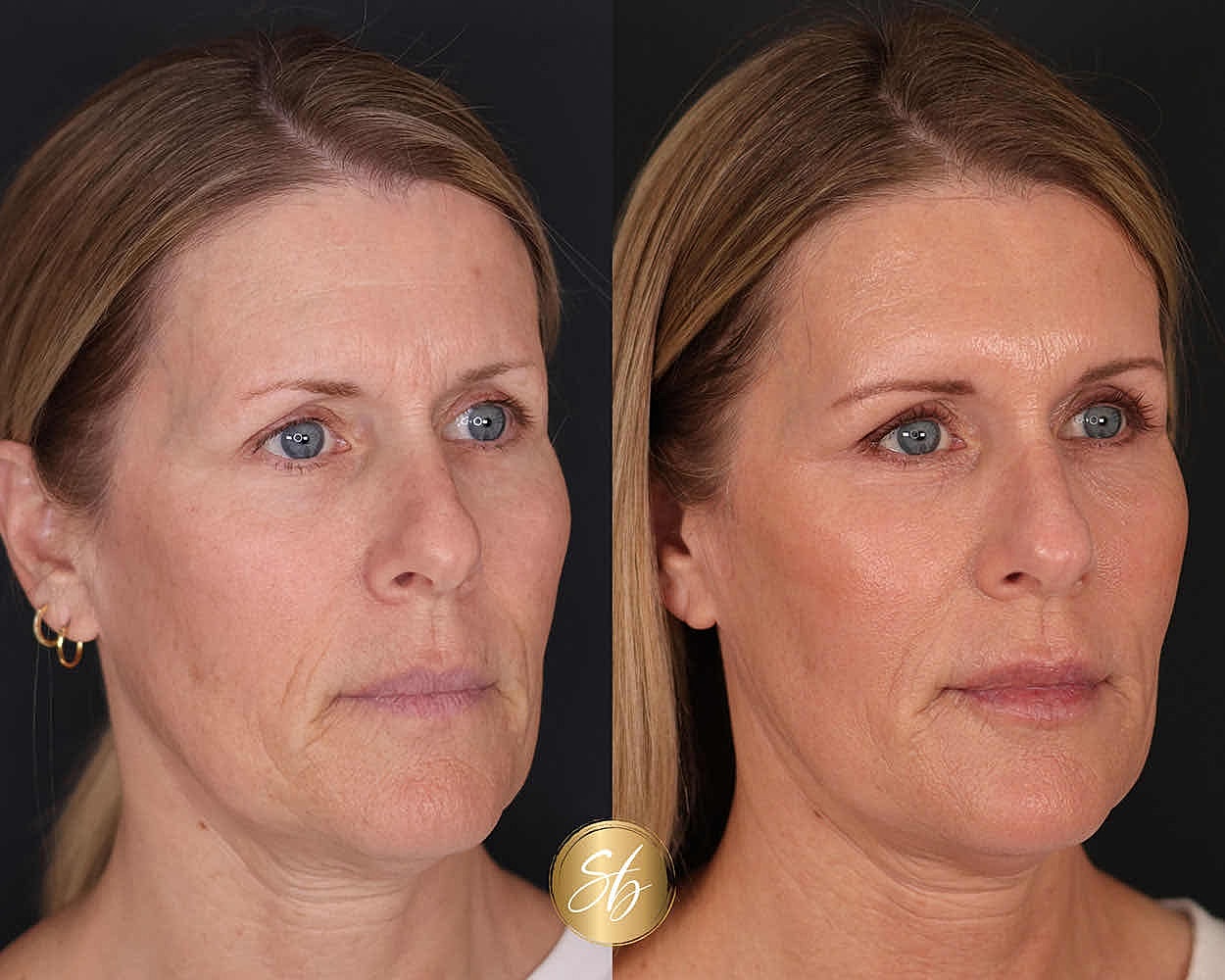 Before and after facial treatment comparison image.