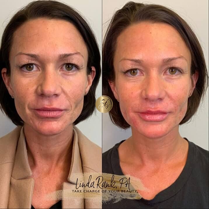 Lower Face Filler Before & After