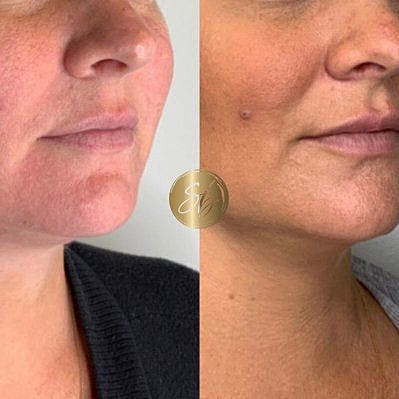 Lower Face Filler Before & After