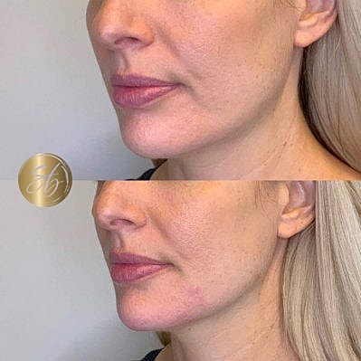 Lower Face Filler Before & After