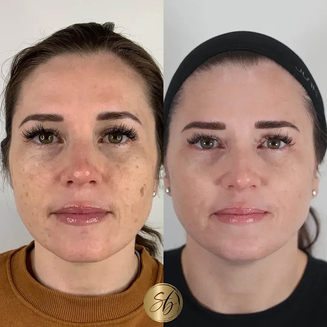 BBL Laser Before & After