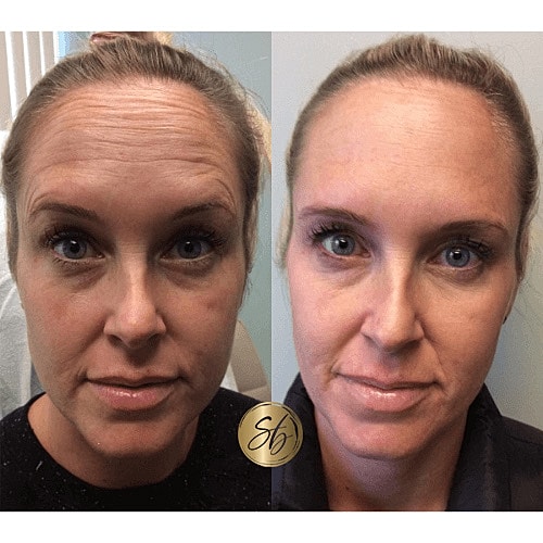 Botox Before & After