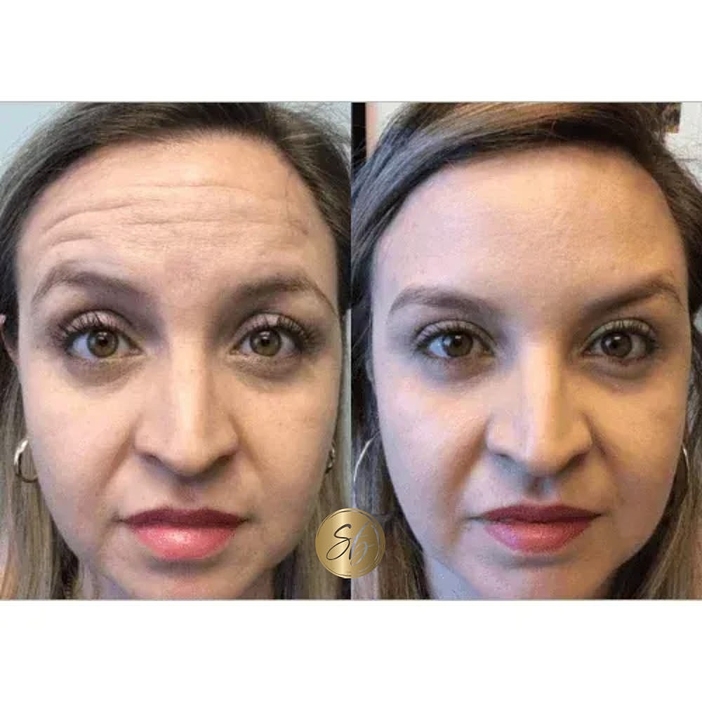 Botox Before & After