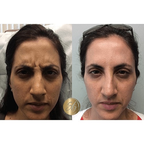 Botox Before & After