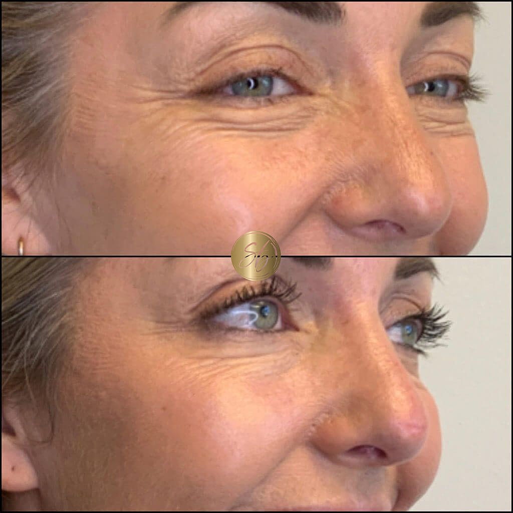 Botox Before & After