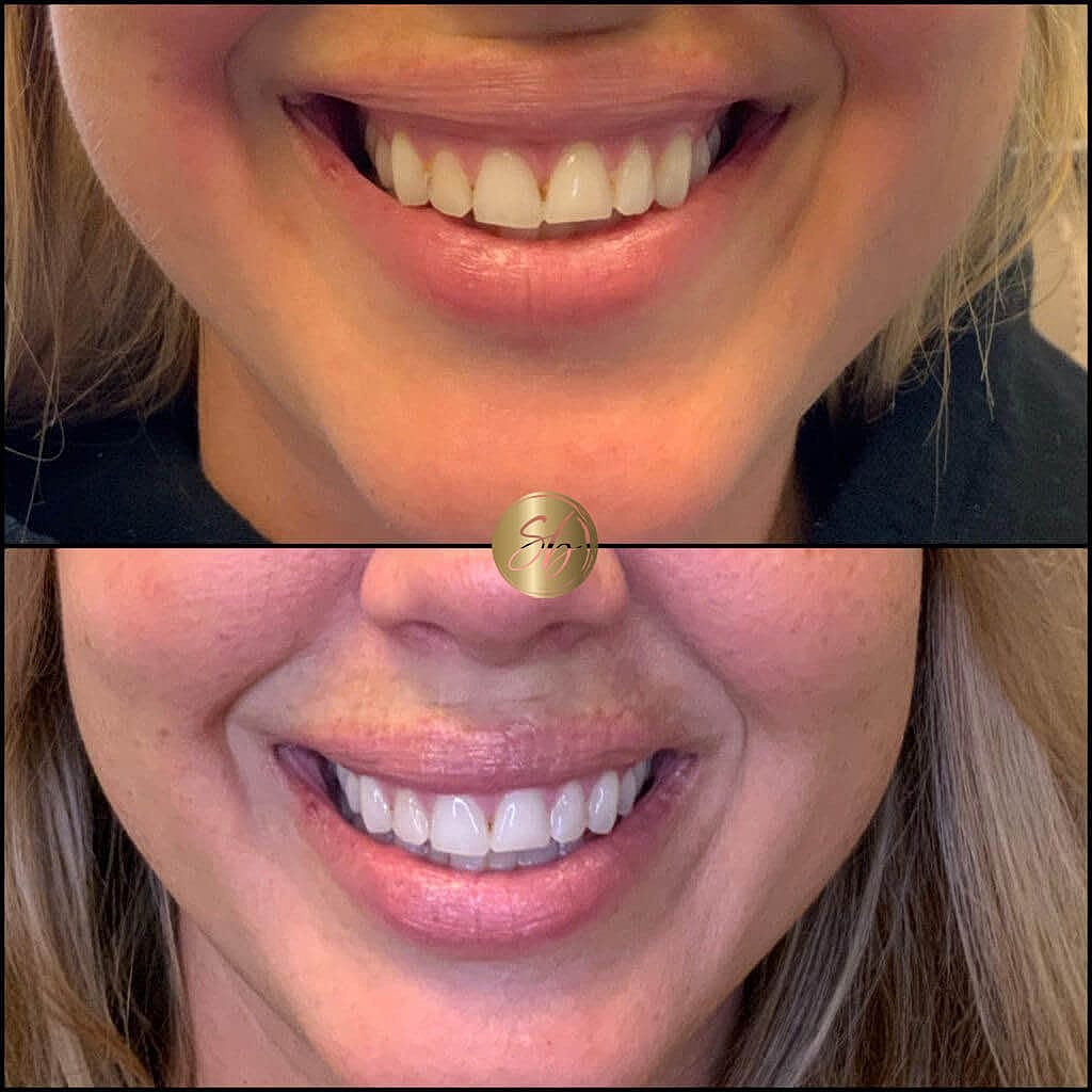 Botox Before & After