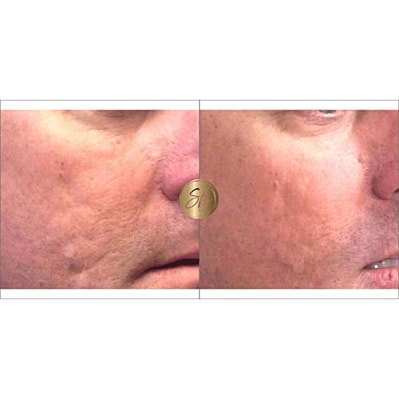 Venus Viva Before & After