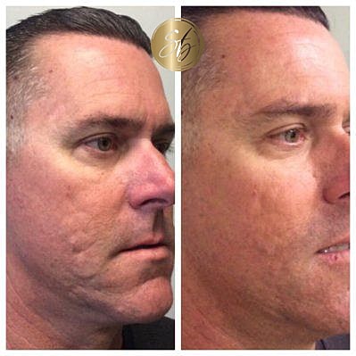 Venus Viva Before & After