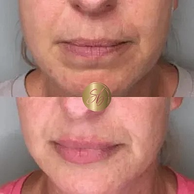 Lip Fillers Before & After