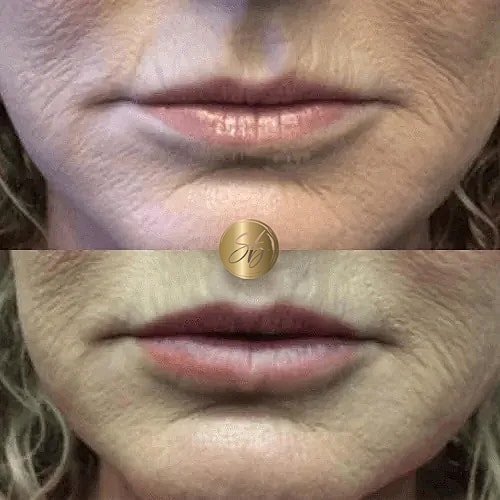 Lip Fillers Before & After