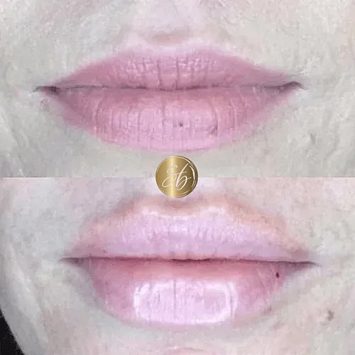 Lip Fillers Before & After