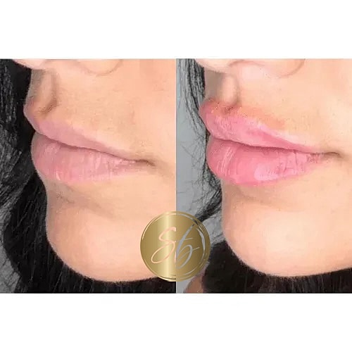 Lip Fillers Before & After