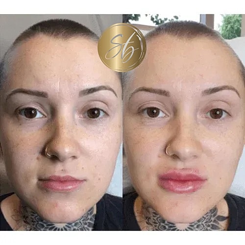 Lip Fillers Before & After