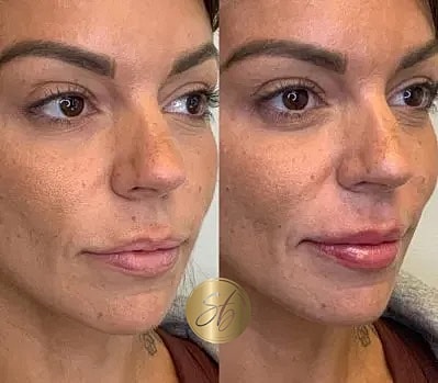 Lip Fillers Before & After