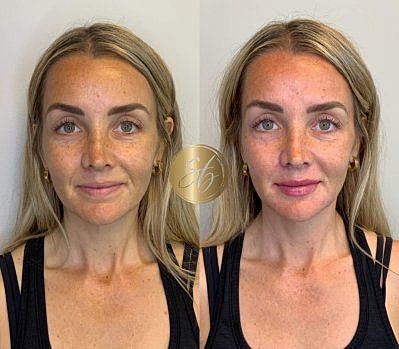 Lip Fillers Before & After