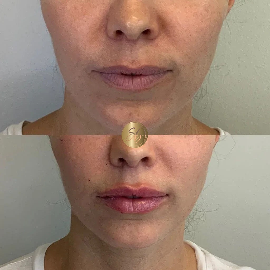 Lip Fillers Before & After