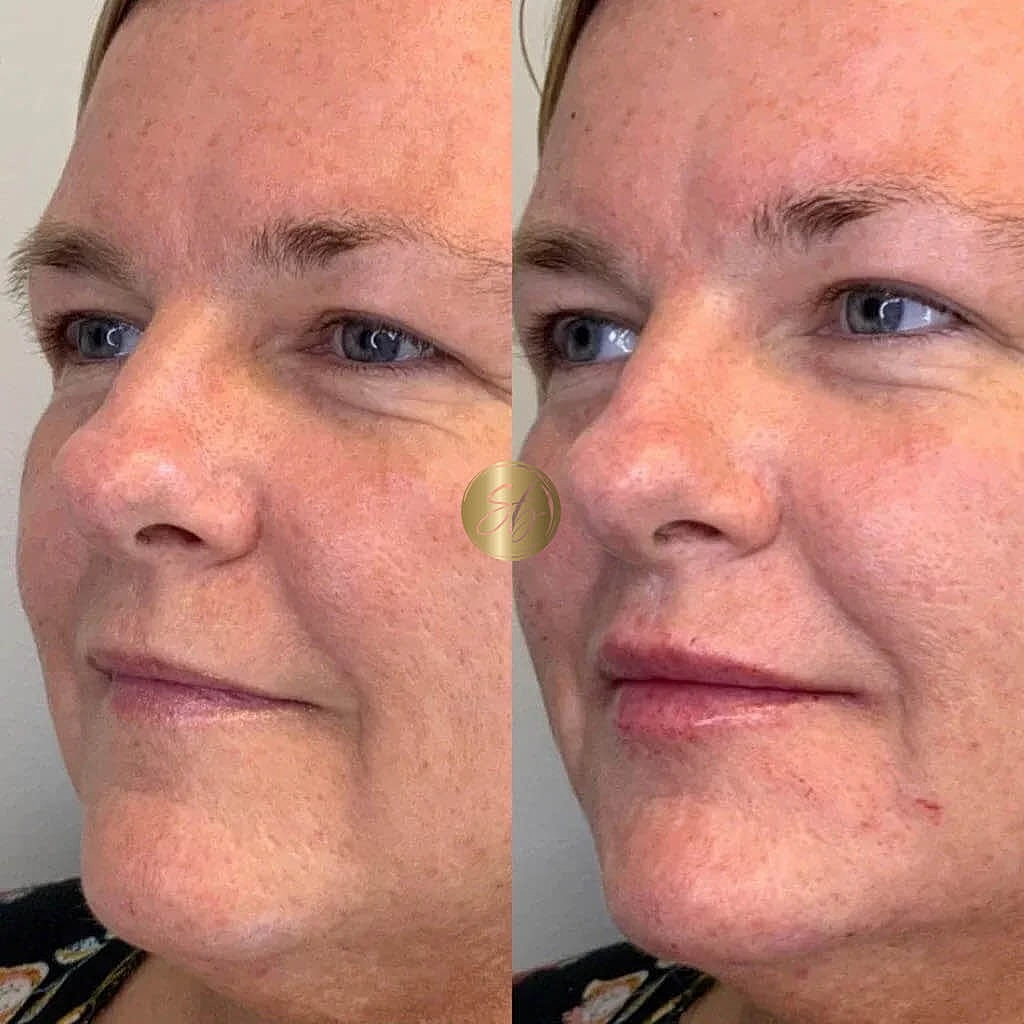 Lip Fillers Before & After