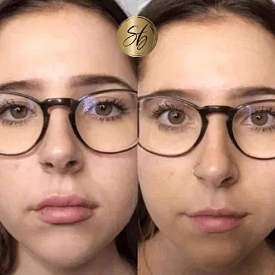 Lip Fillers Before & After
