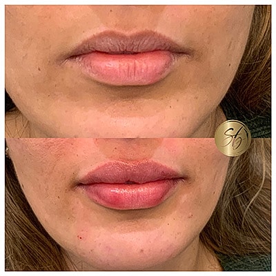Lip Fillers Before & After