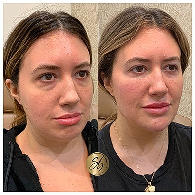 Lip Fillers Before & After