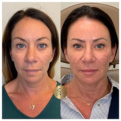 Lip Fillers Before & After