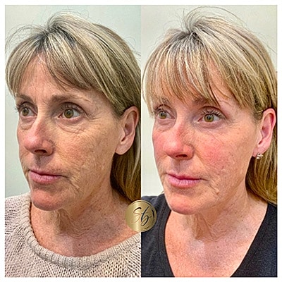 Lip Fillers Before & After