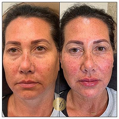 Lip Fillers Before & After