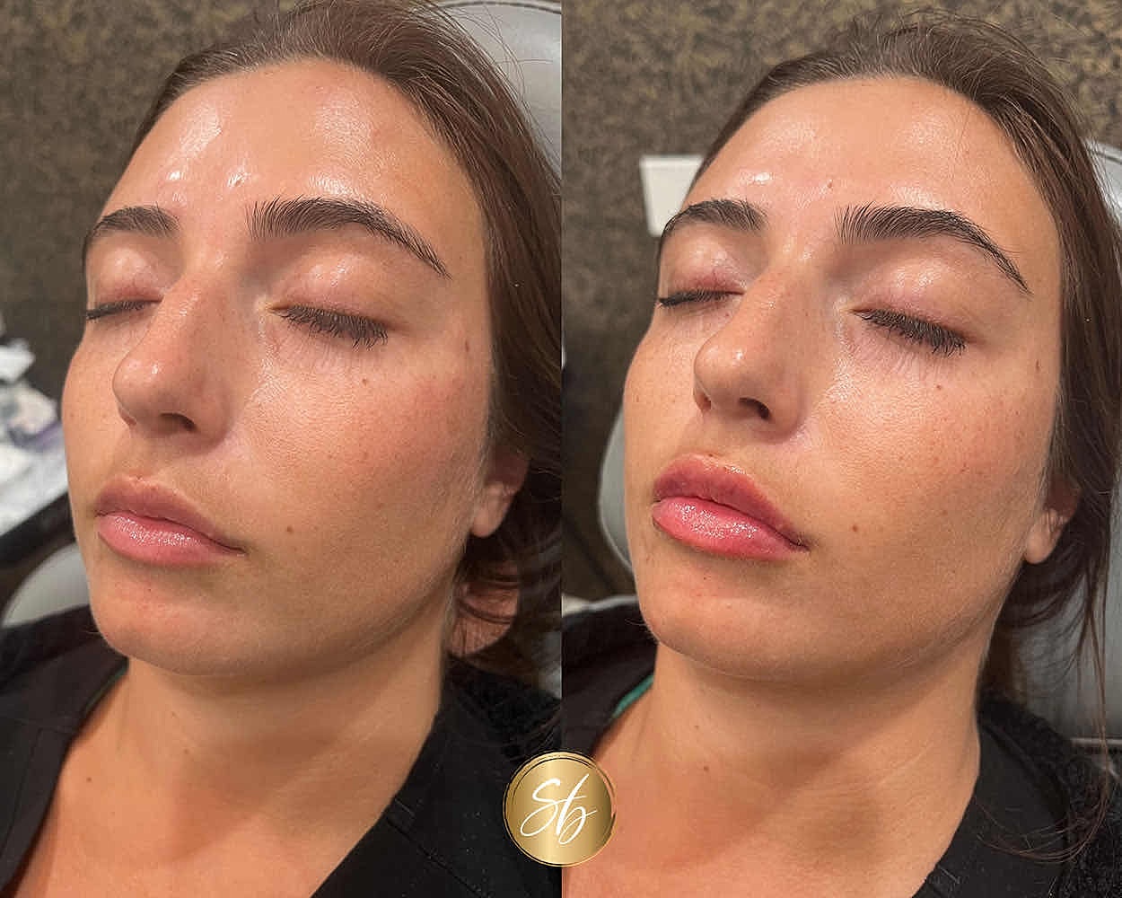 Before and after facial treatment comparison.