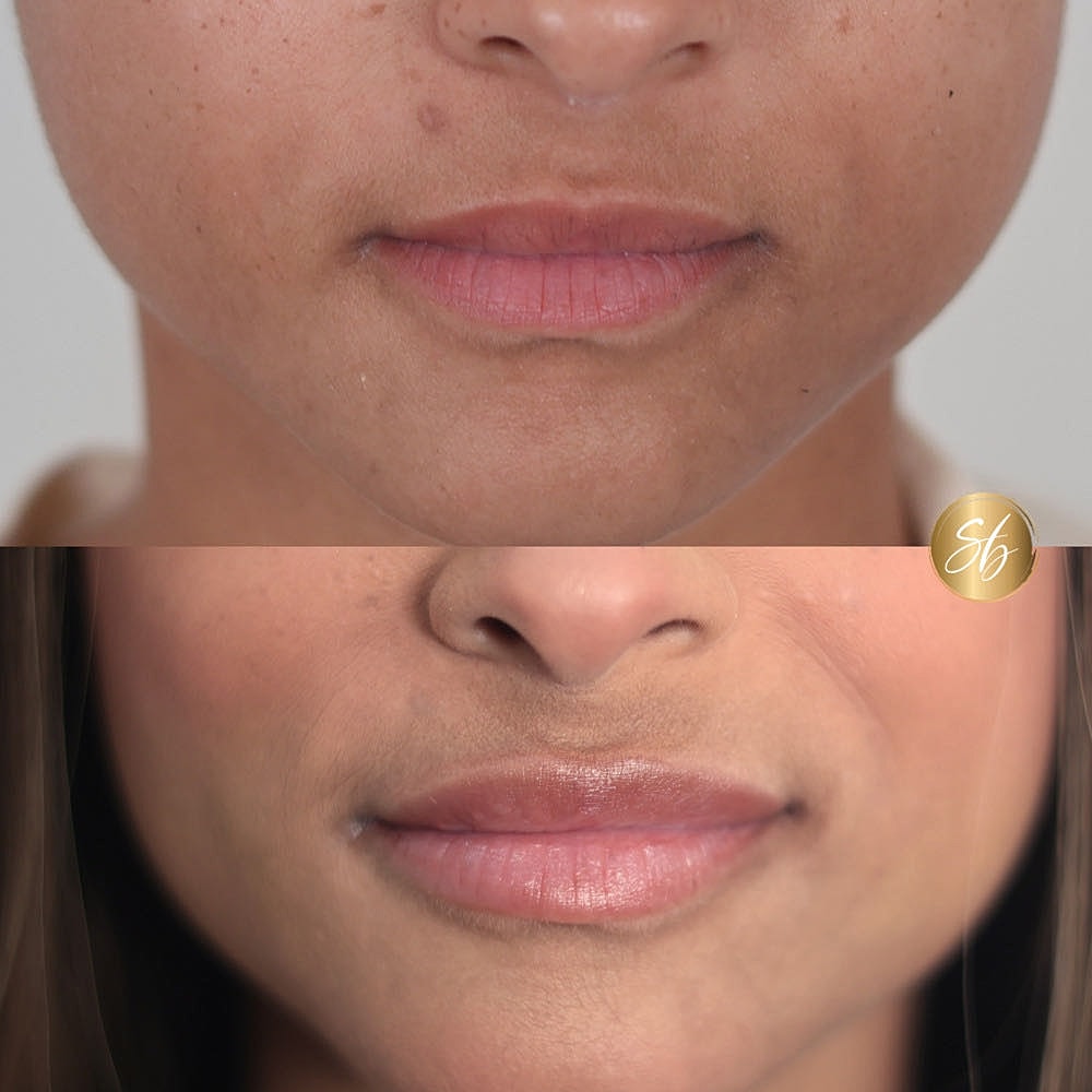 Before and after lip treatment comparison.