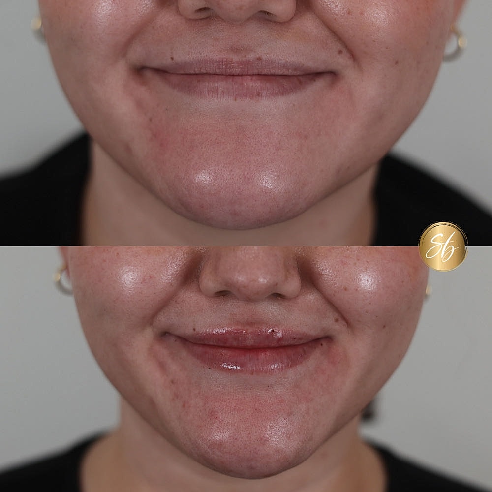 Before and after lip treatment comparison.