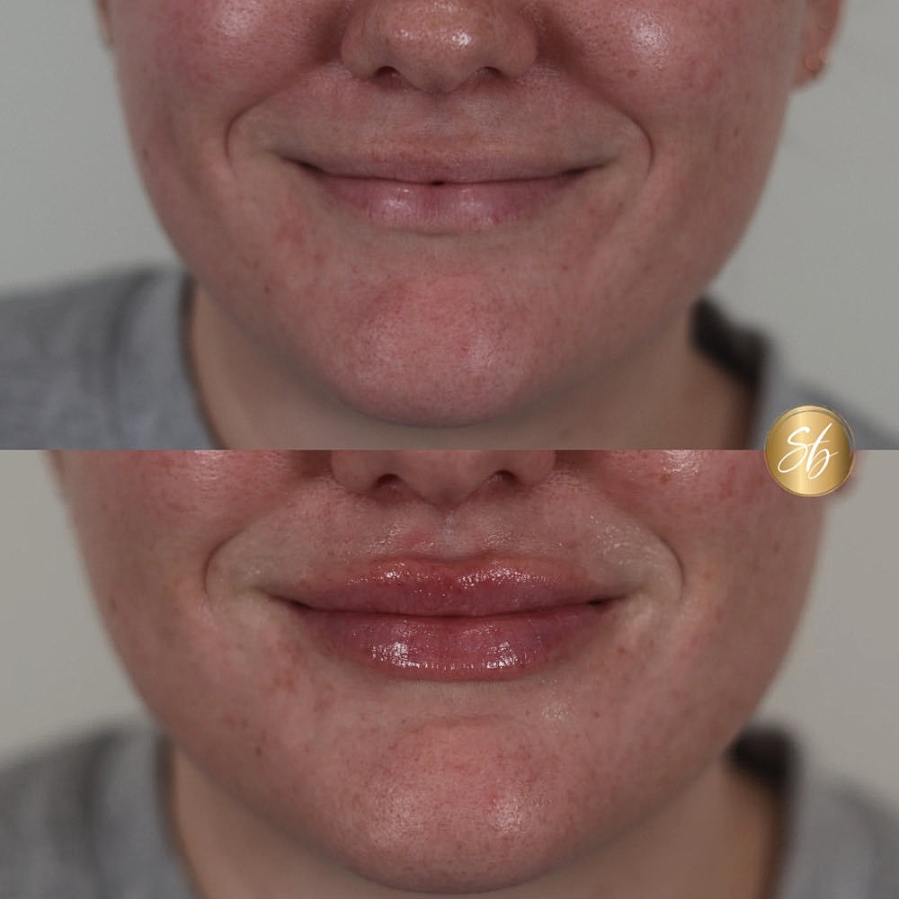 Before and after lip enhancement comparison photo.