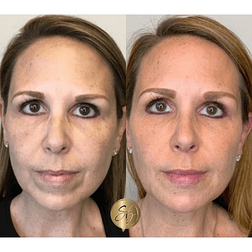 Facial Fillers Before & After