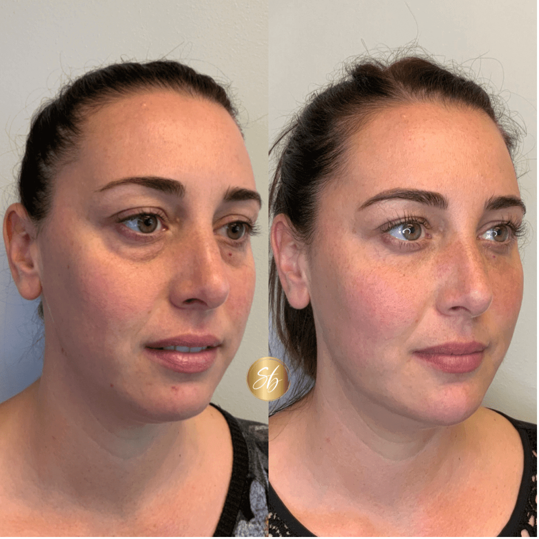 Facial Fillers Before & After