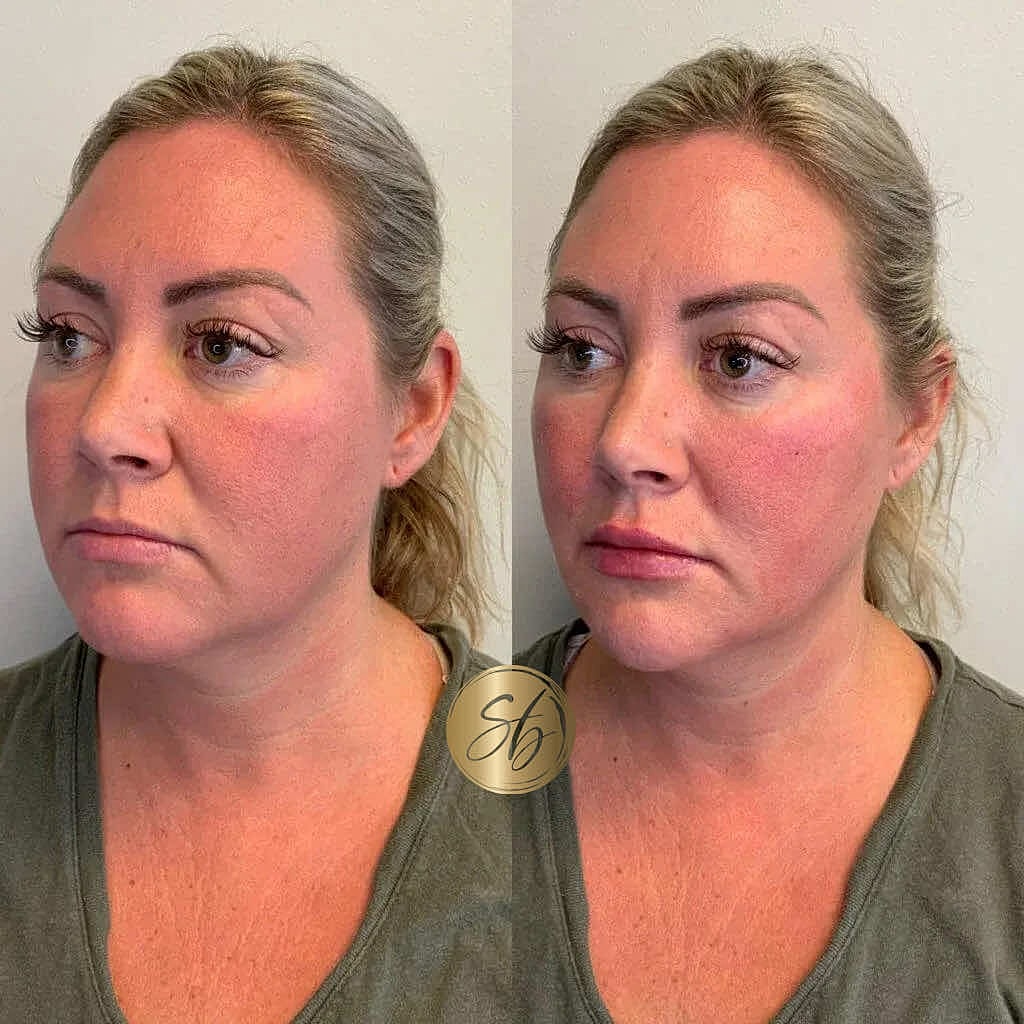 Facial Fillers Before & After