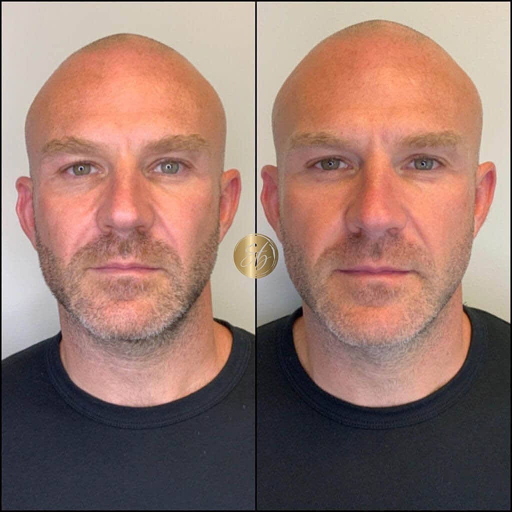 Facial Fillers Before & After