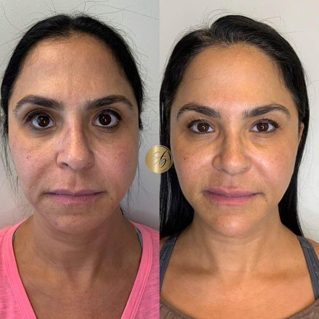 Facial Fillers Before & After