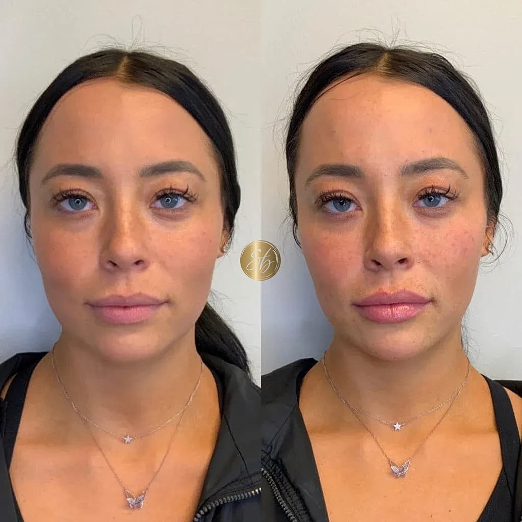 Facial Fillers Before & After