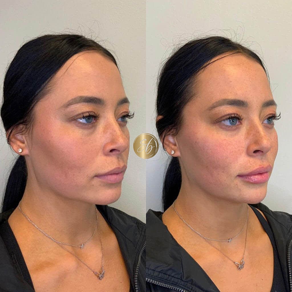 Facial Fillers Before & After