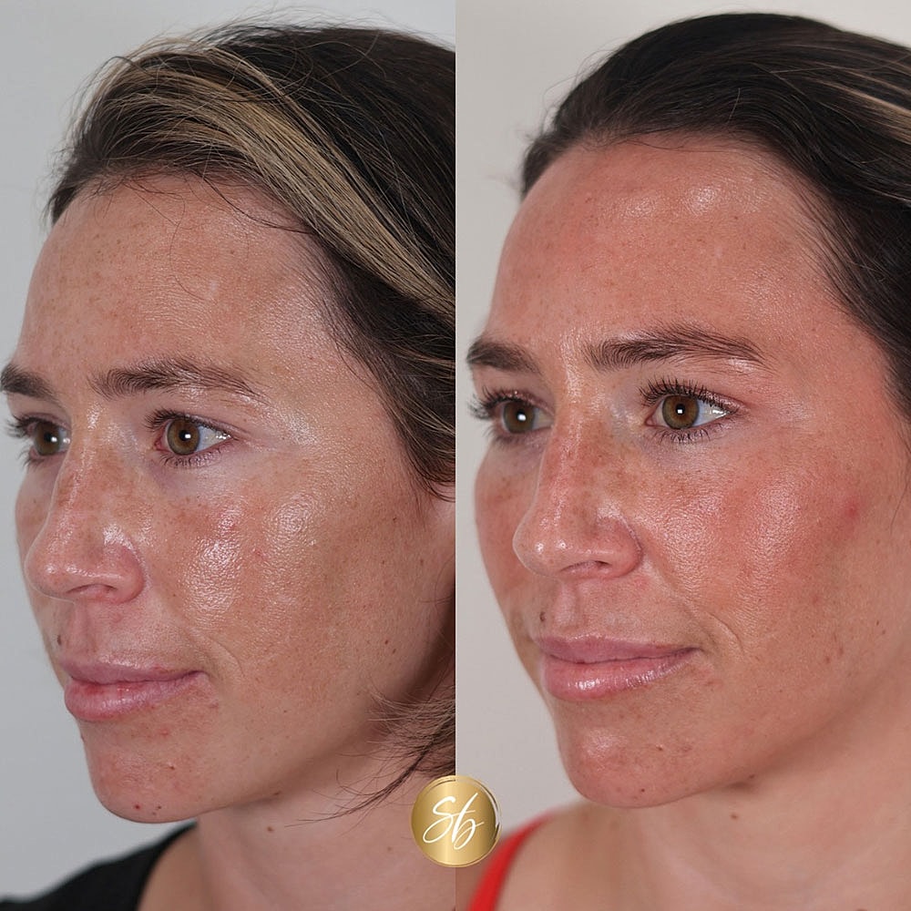 Before and after skincare treatment comparison.