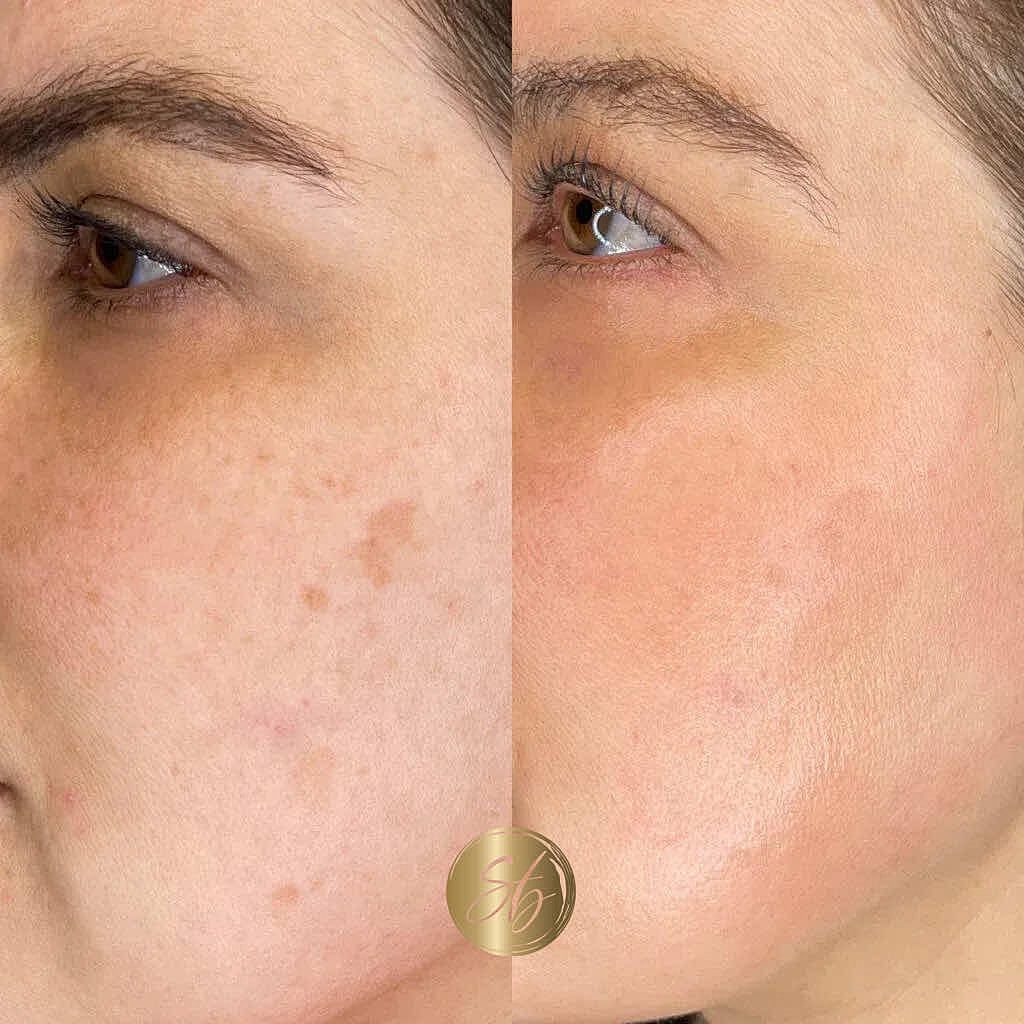 Cosmelan Peel Before & After