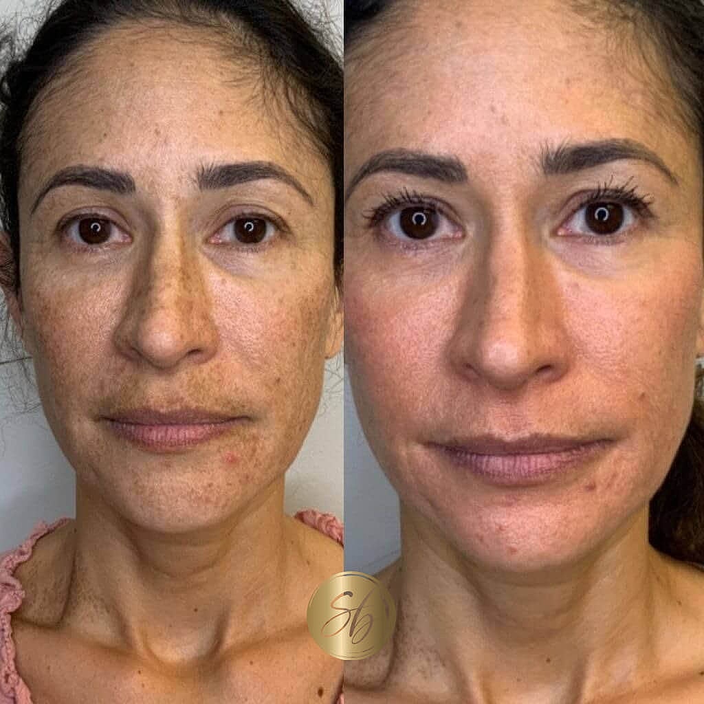 Cosmelan Peel Before & After